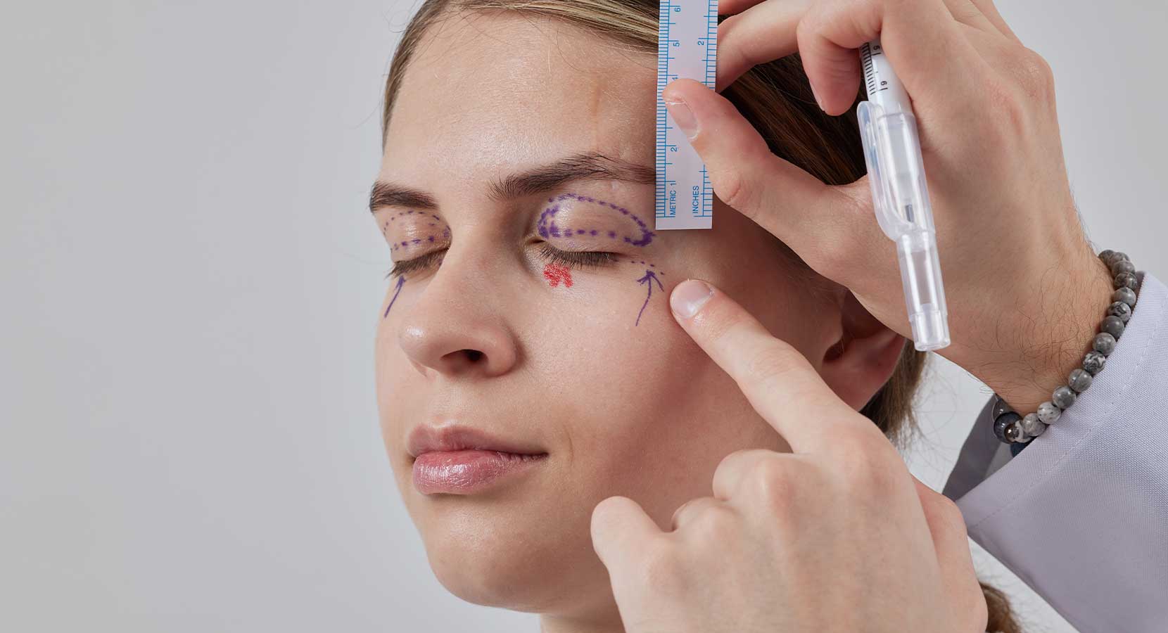 Upper Blepharoplasty 1 Ust ve Alt blefaroplasti dr yunu saglam 2